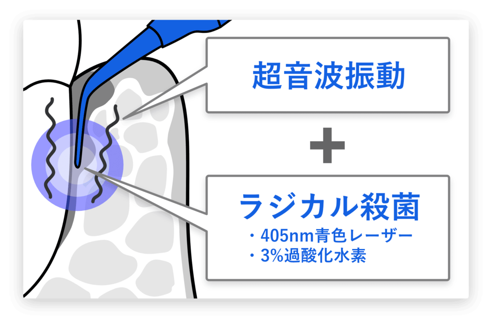 世田谷北沢 医療法人社団 燦陽会 下北沢駅前歯科クリニック 高い殺菌力と再発防止効果