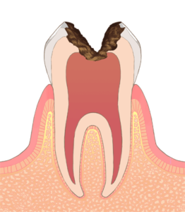重度虫歯の治療