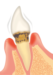 歯周病の治療と定期健診について