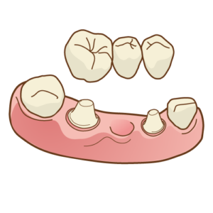 抜歯後の治療