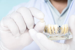 インプラント治療における仮歯の役割とは？仮歯期間中の注意点も解説