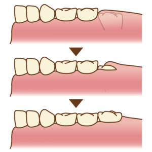 生え変わり期の虫歯の予防