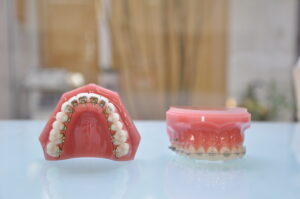 ワイヤー矯正の装置をつけられた歯科模型