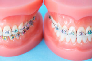 歯の矯正の費用相場！種類・プロセスごとに詳しく解説！