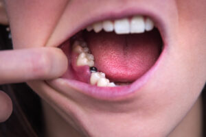 奥歯をインプラントにする治療は難しい？治療のメリットと注意点とは