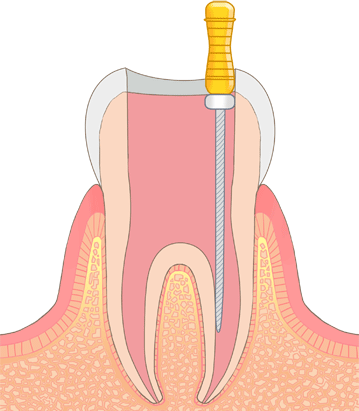 神経を取る処置をした歯に起こること