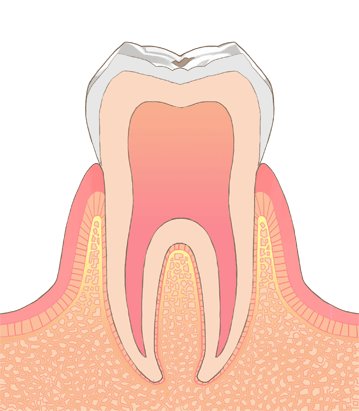 初期虫歯とは
