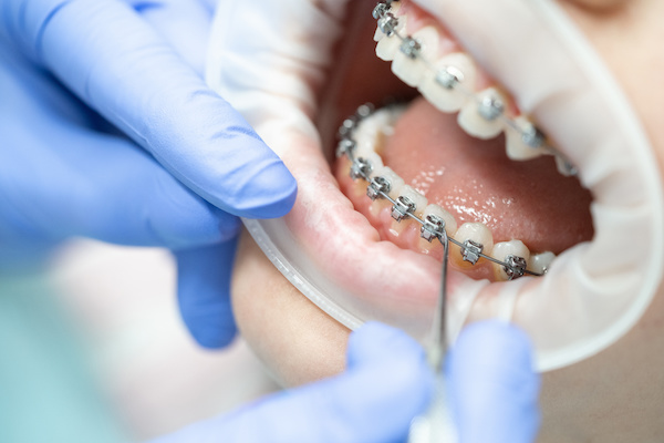 歯列矯正中の虫歯治療