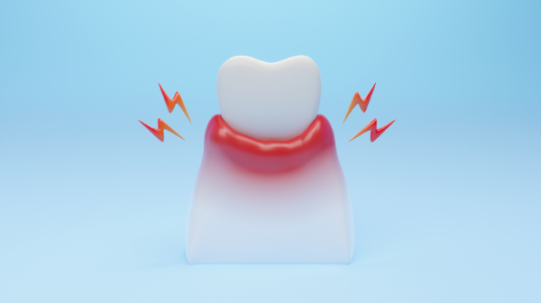 歯周病で腫れた歯茎のイメージ