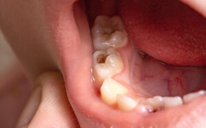 奥歯にできた子どもの虫歯