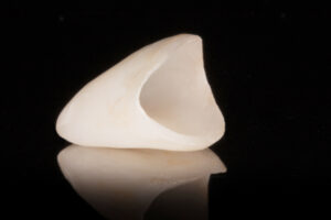 オールセラミックのかぶせ物