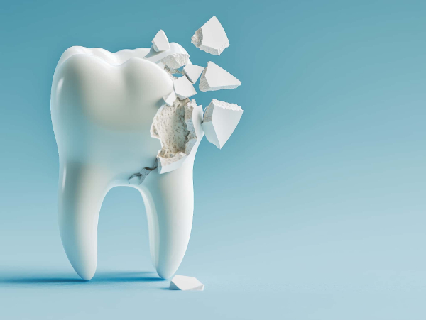 歯ぎしりでセラミックの歯が破損するイメージ