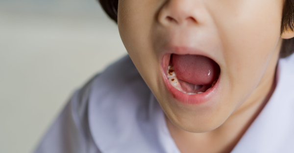 インビザライン・ファーストの 治療中に虫歯になった子ども