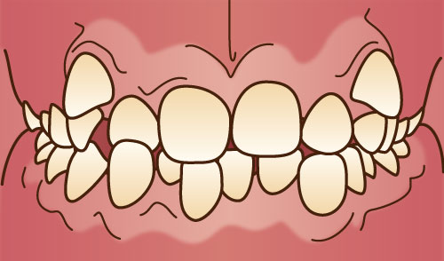 世田谷北沢 医療法人社団 燦陽会 下北沢駅前歯科クリニック 前歯のがたつき（叢生）