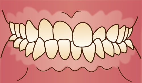 世田谷北沢 医療法人社団 燦陽会 下北沢駅前歯科クリニック 交叉咬合