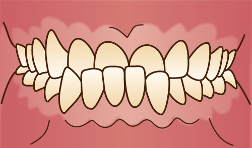 世田谷北沢 医療法人社団 燦陽会 下北沢駅前歯科クリニック 受け口（下顎前突）