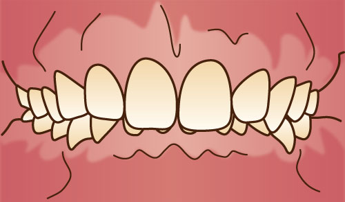 世田谷北沢 医療法人社団 燦陽会 下北沢駅前歯科クリニック 過蓋咬合