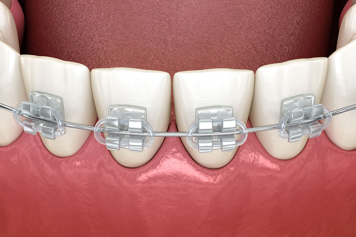 世田谷北沢 医療法人社団 燦陽会 下北沢駅前歯科クリニック ワイヤー矯正