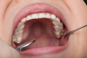 歯科検診で口腔内のチェックを受ける様子