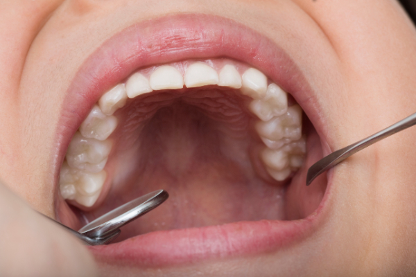 歯科検診で口腔内のチェックを受ける様子