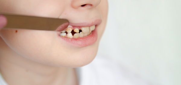 口呼吸をし続けると虫歯になるリスクが高くなる様子