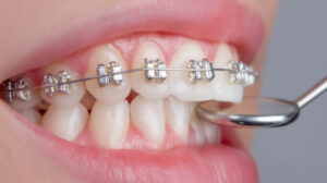 出っ歯の矯正治療の様子