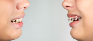 矯正を始めた出っ歯の子ども