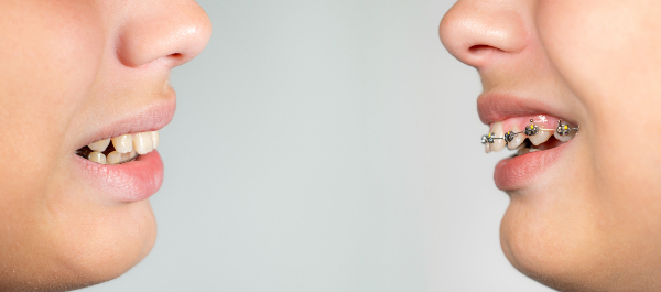 子どもが出っ歯のままだと危険？矯正を始めるタイミングも解説