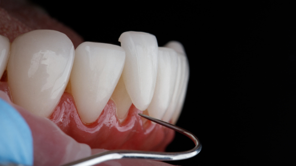 十分に接着できていないラミネートベニア