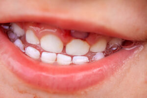 歯肉炎になった子どもの口もとのイメージ