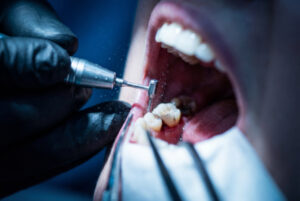 患者の根管治療をしている歯科医師