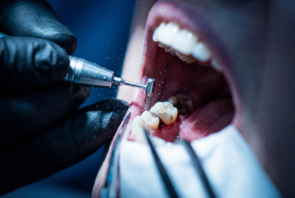 患者の根管治療をしている歯科医師