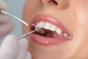 オフィスホワイトニング前に歯石除去をする様子