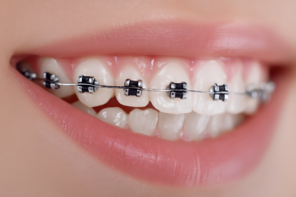 ワイヤー矯正中の女性の口元