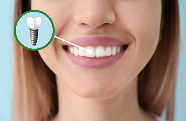 前歯をインプラントにするイメージ