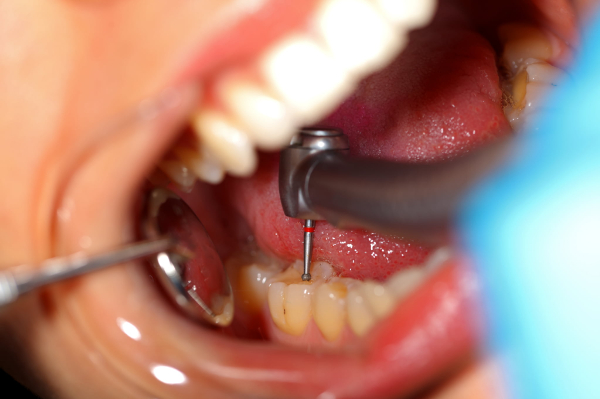 奥歯を治療している患者の口の中のイメージ