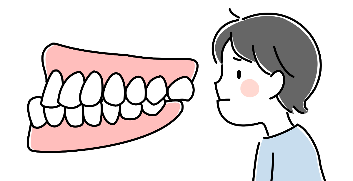 受け口の子どもの歯の状態イメージ