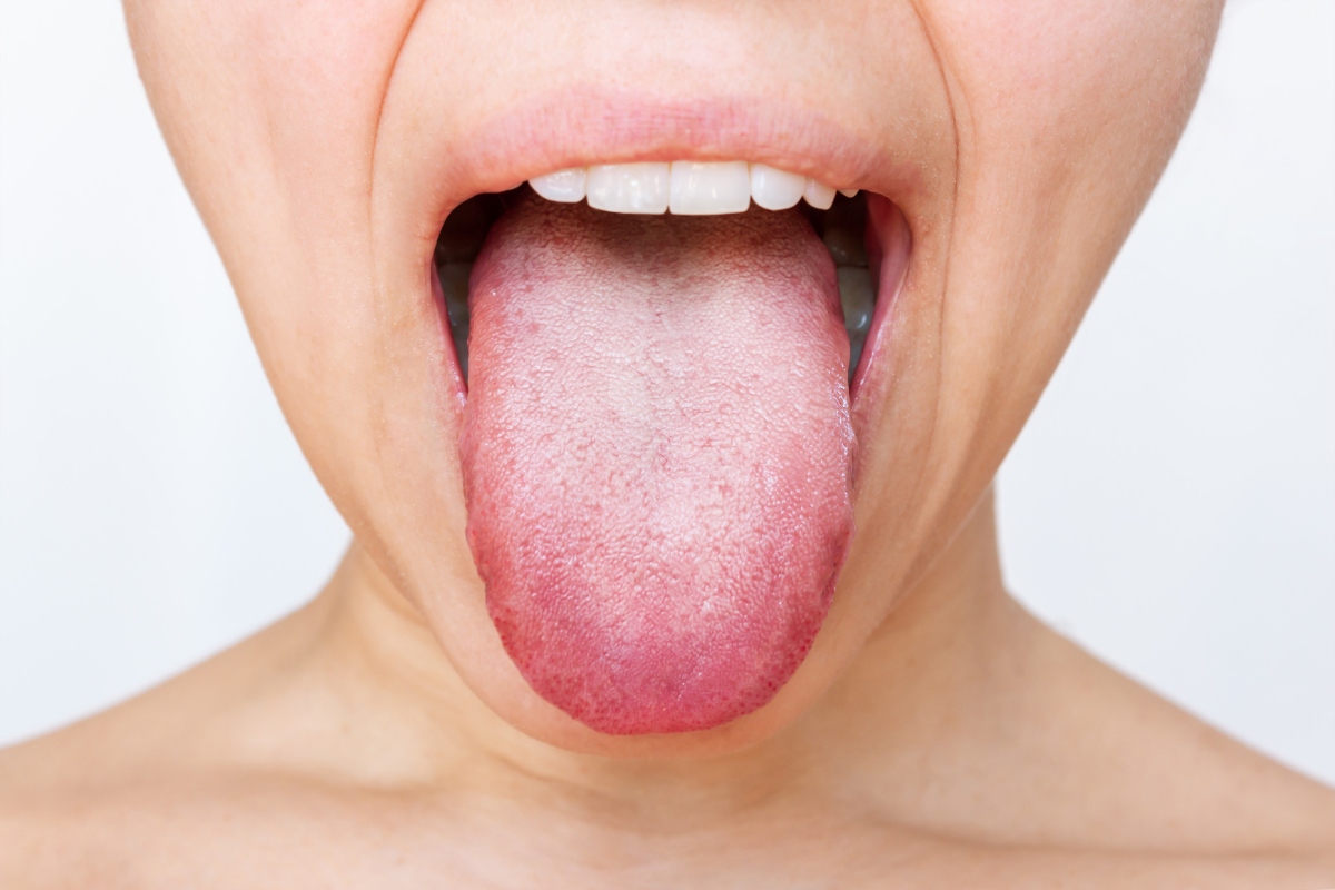 歯周病以外で考えられる口臭の原因である舌苔(ぜったい)