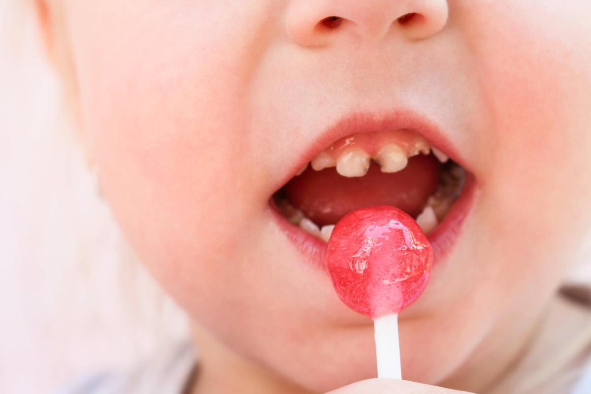 飴を食べる虫歯のある子どもの口元