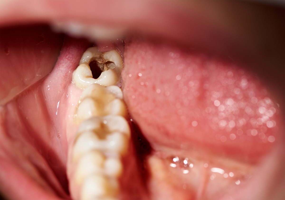 親知らずが虫歯になったら！治療法と予防する方法